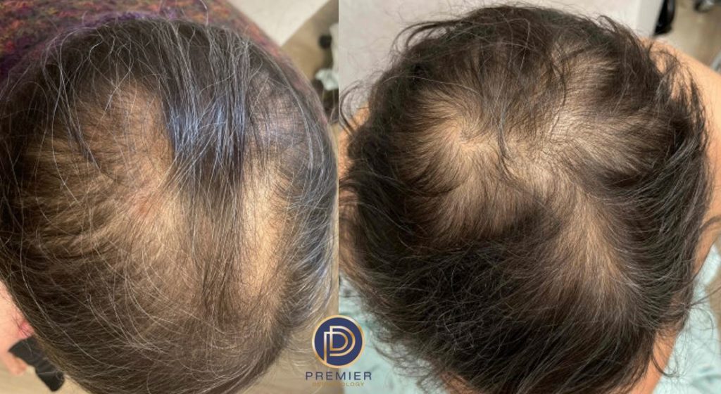 Platelet Rich Plasma Before and After Gallery by Dr. Burnett in Wellesley Massachusetts