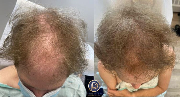 Hair Loss Before and After Gallery by Dr. Burnett in Wellesley Massachusetts