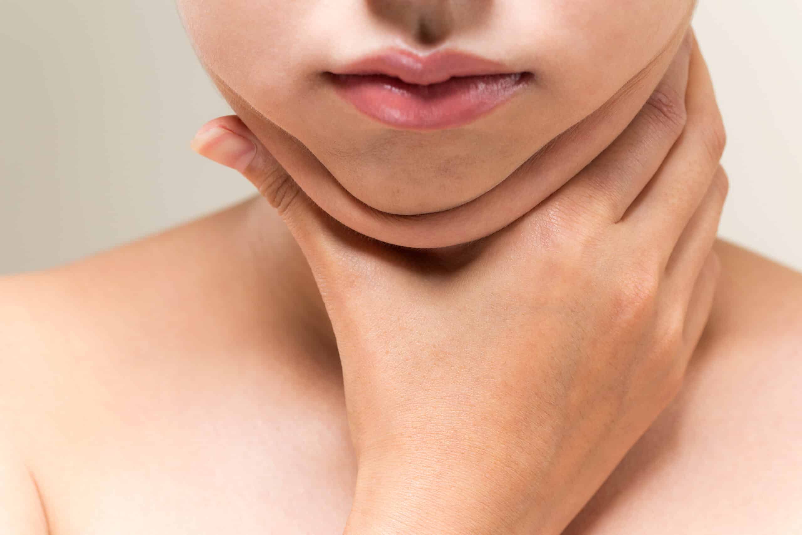 二重顎・若い女性 kybella wellesley premier dermatology