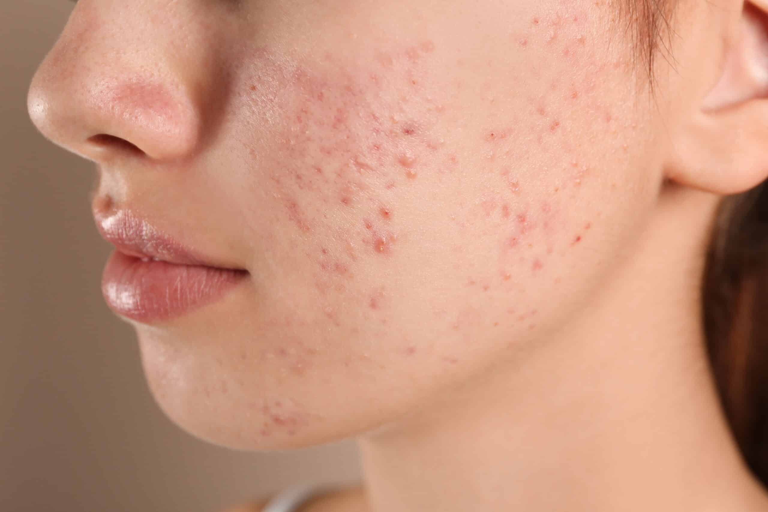 acne 1 Acne-Rosacea 2 wellesley premier dermatology