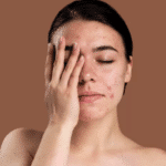 The Acne Series: Accutane Trumps Acne