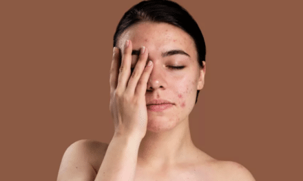 The Acne Series: Accutane Trumps Acne