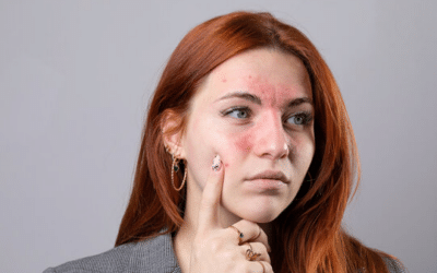 The Acne Series: Treating Acne & Eczema Simultaneously