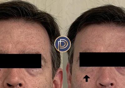 ndyag before and after photo by premier dermatology in wellesley ma