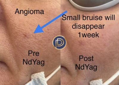 ndyag before and after photo by premier dermatology in wellesley ma