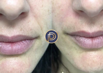 nlf filler before and after photo by premier dermatology in wellesley ma