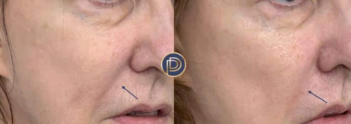 nlf filler before and after photo by premier dermatology in wellesley ma
