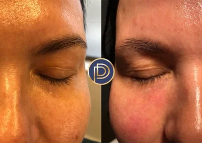 tear trough filler before and after photo by premier dermatology in wellesley ma