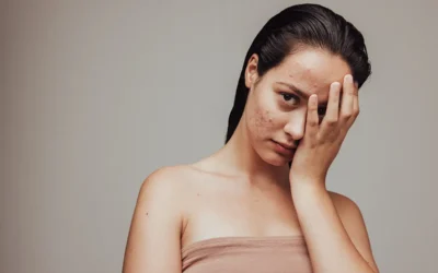 The Acne Series: Accutane Trumps Acne