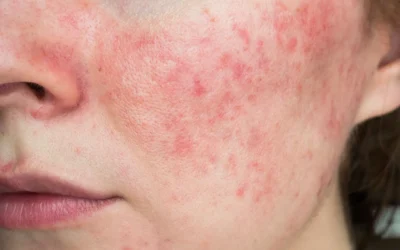 Common Skin Conditions and Their Treatments