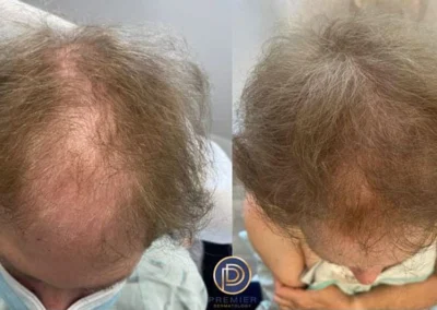 hair loss before and after photo by premier dermatology in wellesley ma