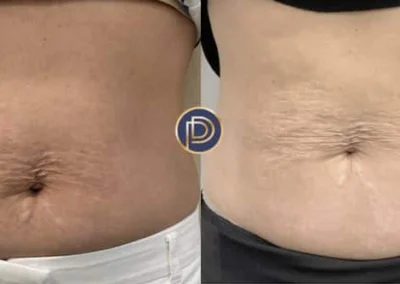 morpheus before and after photo by premier dermatology in wellesley ma