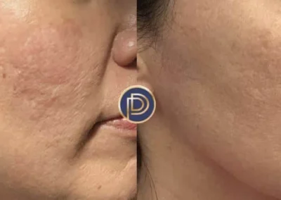 morpheus before and after photo by premier dermatology in wellesley ma