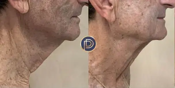 morpheus before and after photo by premier dermatology in wellesley ma