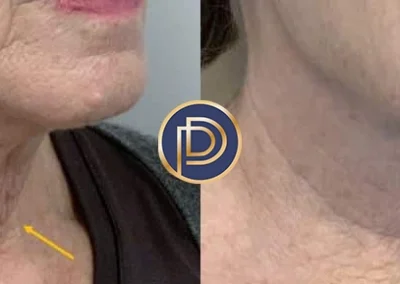 morpheus before and after photo by premier dermatology in wellesley ma