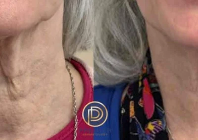 morpheus before and after photo by premier dermatology in wellesley ma