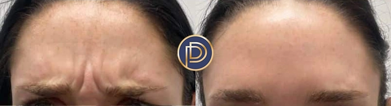 botox dysport xeomin before and after photo by premier dermatology in wellesley ma