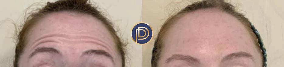 botox dysport xeomin before and after photo by premier dermatology in wellesley ma