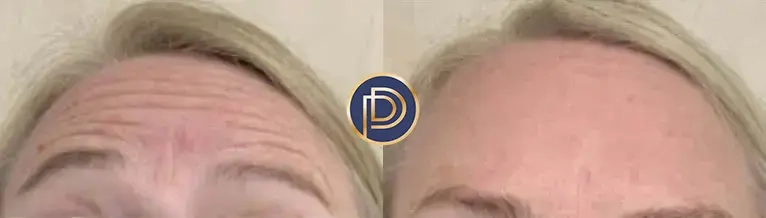 botox dysport xeomin before and after photo by premier dermatology in wellesley ma