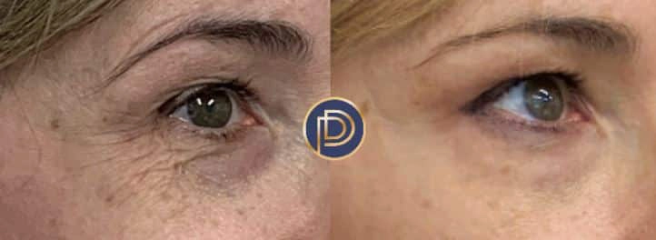 botox dysport xeomin before and after photo by premier dermatology in wellesley ma