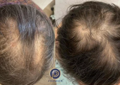platelet rich plasma before and after photo by premier dermatology in wellesley ma