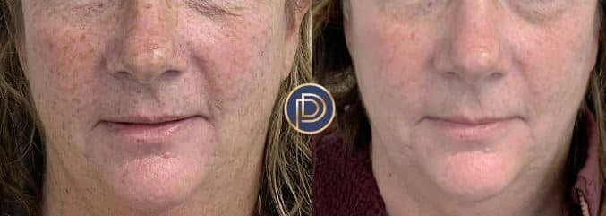 ipl before and after photo by premier dermatology in wellesley ma
