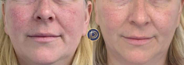 ipl before and after photo by premier dermatology in wellesley ma