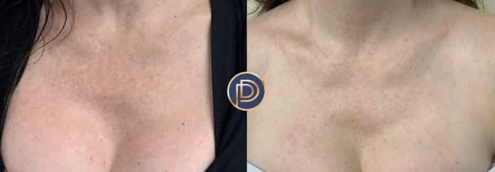 ipl before and after photo by premier dermatology in wellesley ma