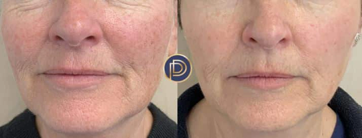 ipl before and after photo by premier dermatology in wellesley ma