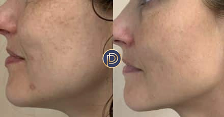 ipl before and after photo by premier dermatology in wellesley ma