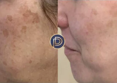 ipl before and after photo by premier dermatology in wellesley ma
