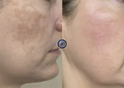 ipl before and after photo by premier dermatology in wellesley ma