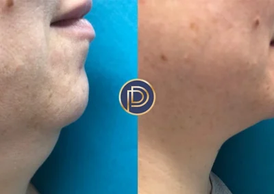 kybella before and after photo by premier dermatology in wellesley ma