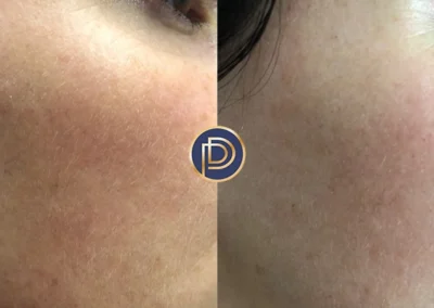 laser before and after photo by premier dermatology in wellesley ma