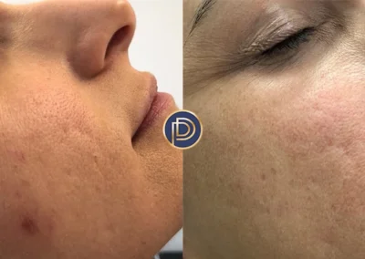 laser before and after photo by premier dermatology in wellesley ma