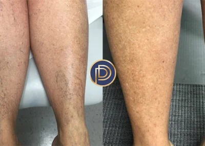 leg veins before and after photo by premier dermatology in wellesley ma