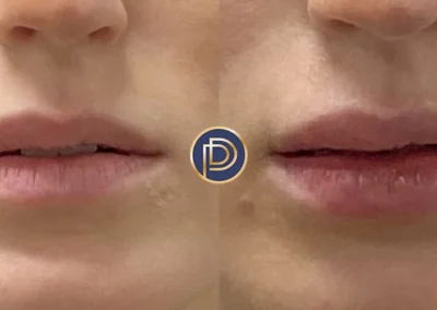 lip filler before and after photo by premier dermatology in wellesley ma