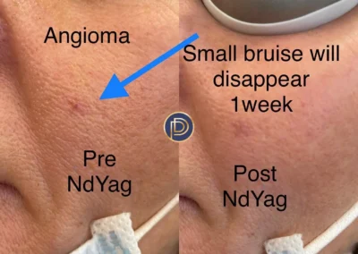 Nd:YAG before and after photo by premier dermatology in wellesley ma