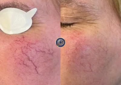 Nd:YAG before and after photo by premier dermatology in wellesley ma