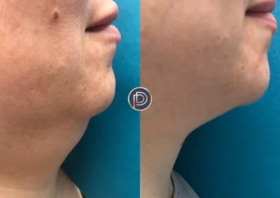 Nd:YAG before and after photo by premier dermatology in wellesley ma