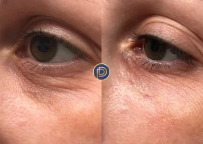 tear trough filler before and after photo by premier dermatology in wellesley ma