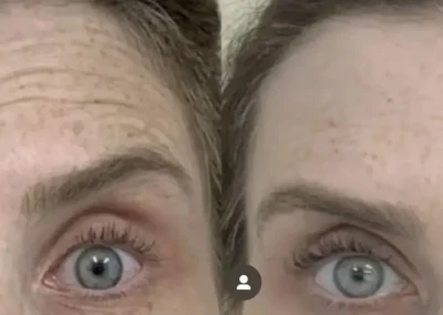 botox before and after photo by premier dermatology in wellesley ma