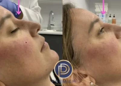 liquid rhinoplasty before and after photo by premier dermatology in wellesley ma
