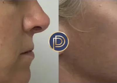 cheek filler before and after photo by premier dermatology in wellesley ma