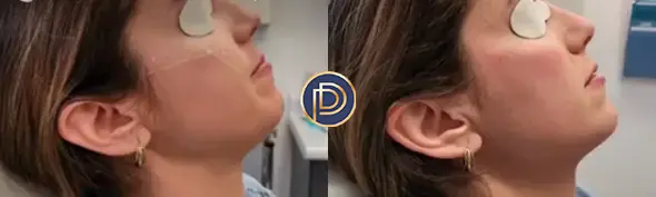 cheek filler before and after photo by premier dermatology in wellesley ma