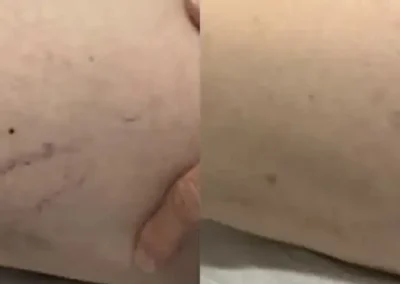 sclerotheraphy before and after photo by premier dermatology in wellesley ma