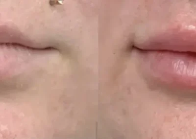 lip filler before and after photo by premier dermatology in wellesley ma
